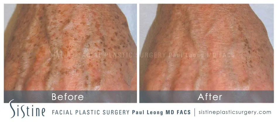 Photofacial Before and After | Leong Facial Plastic Surgery