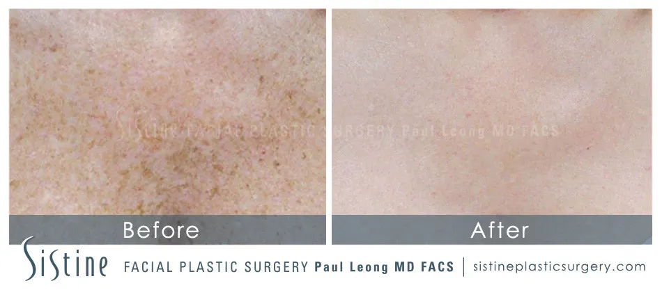Photofacial Before and After | Leong Facial Plastic Surgery