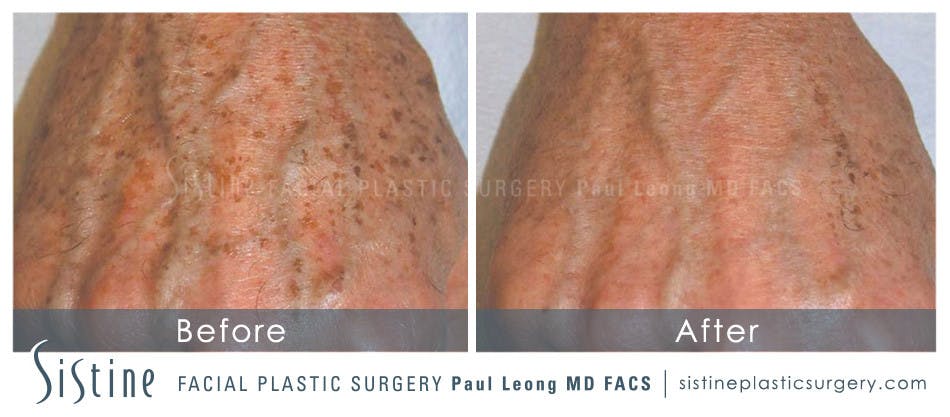 Photofacial Before and After | Leong Facial Plastic Surgery