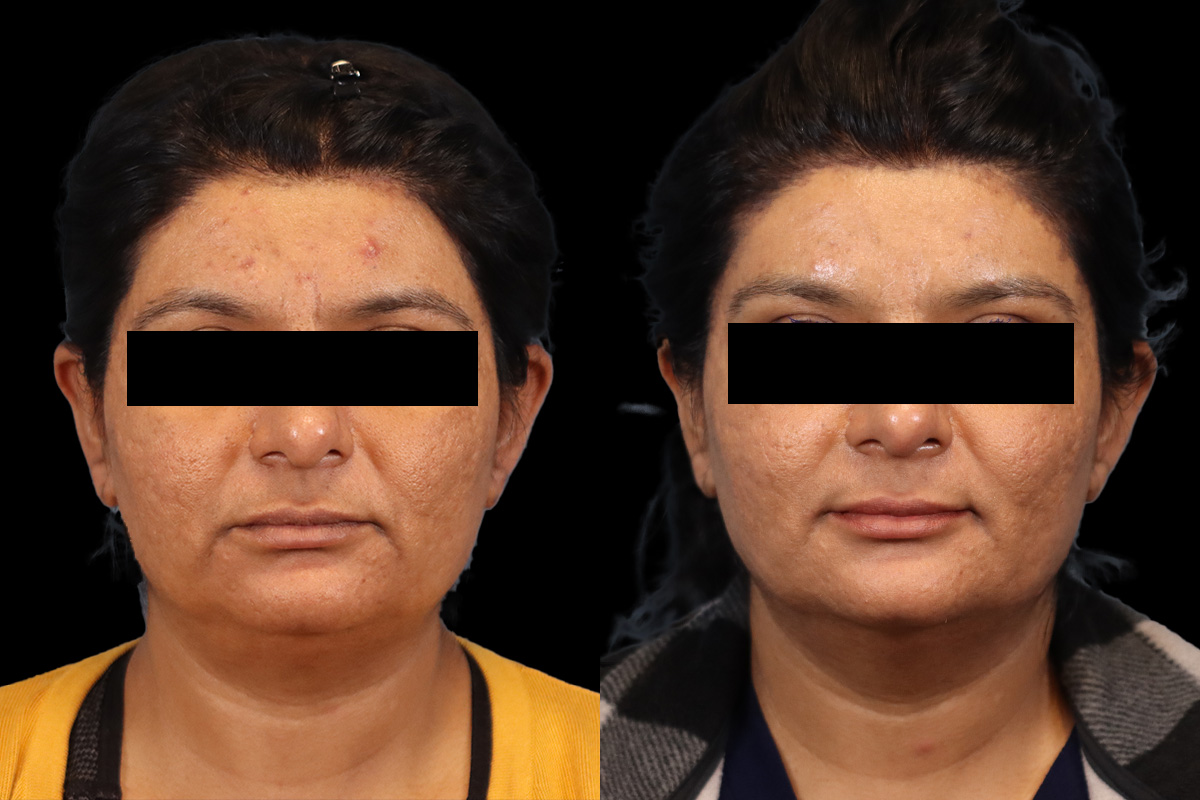 Brow And Forehead Before and After | Leong Facial Plastic Surgery