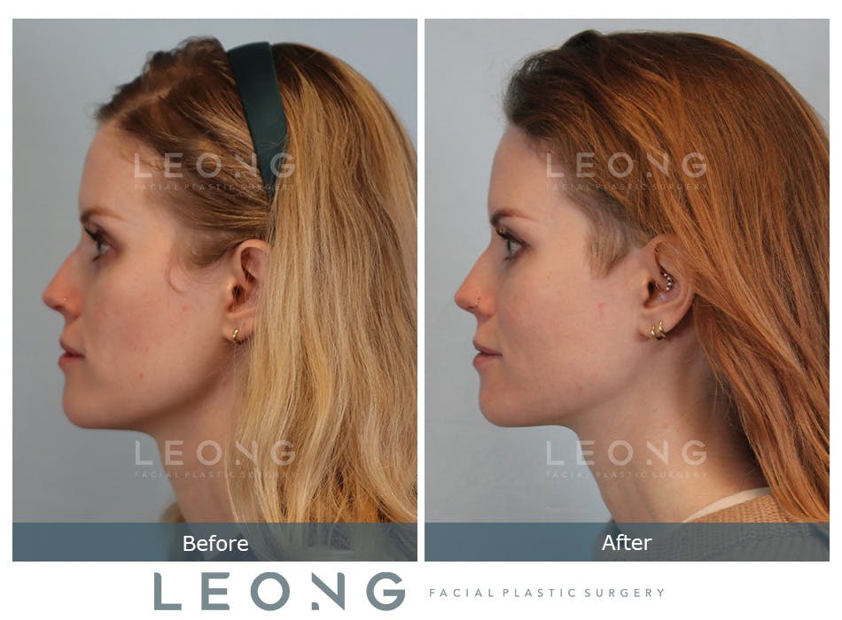 Cheeks Before and After | Leong Facial Plastic Surgery