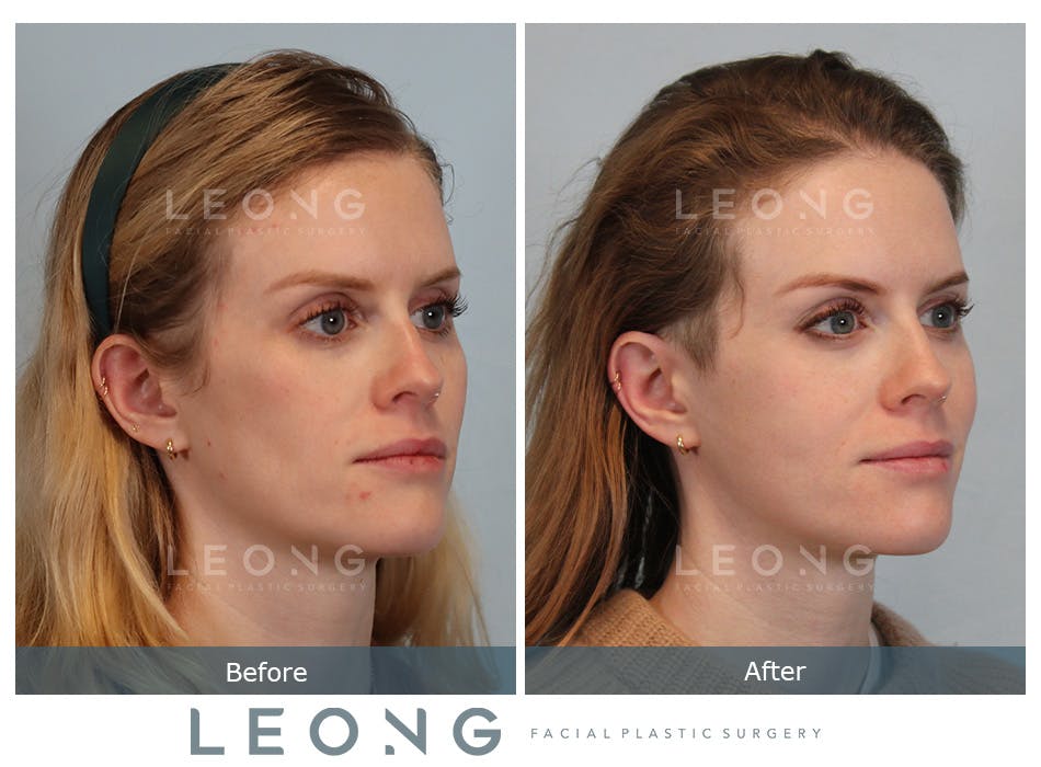 Cheeks Before and After | Leong Facial Plastic Surgery