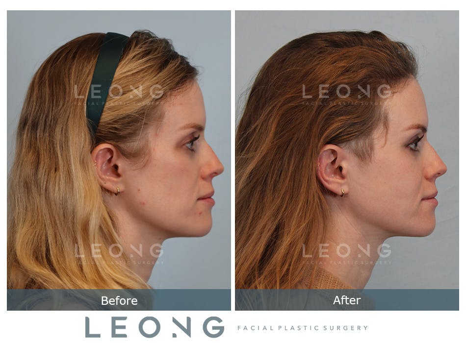 Cheeks Before and After | Leong Facial Plastic Surgery