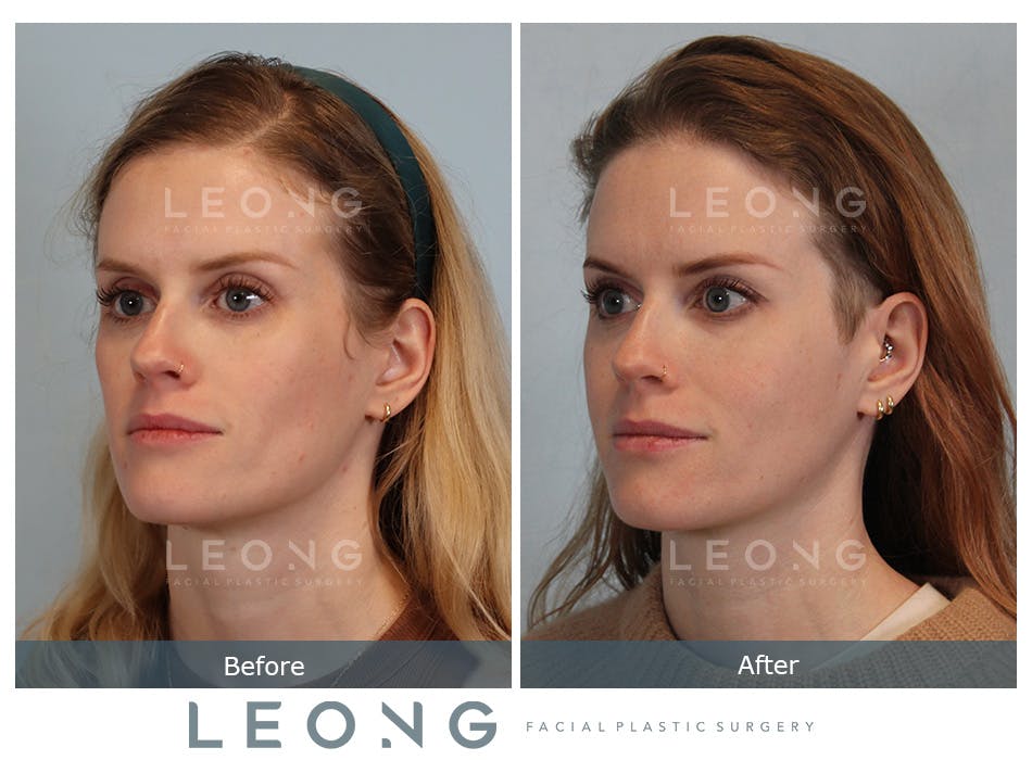 Cheeks Before and After | Leong Facial Plastic Surgery