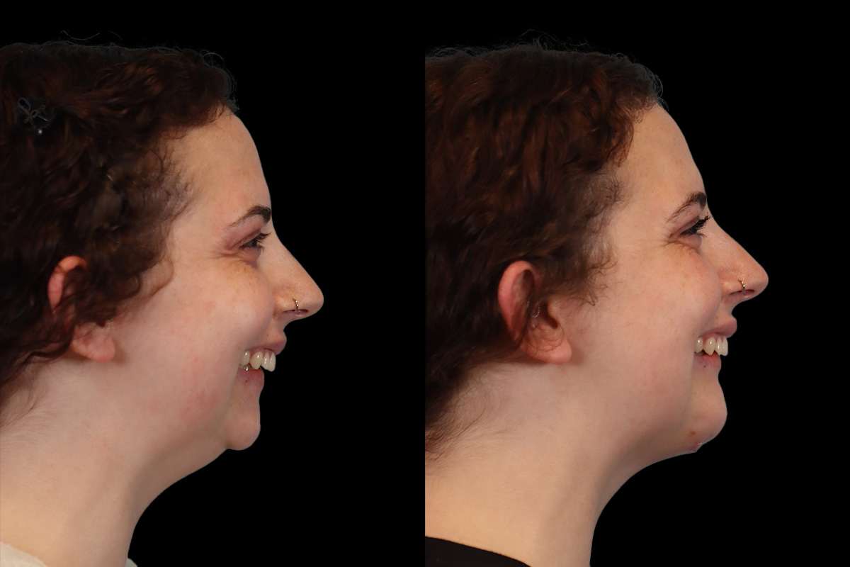 Chin Jaw And Neck Before and After | Leong Facial Plastic Surgery