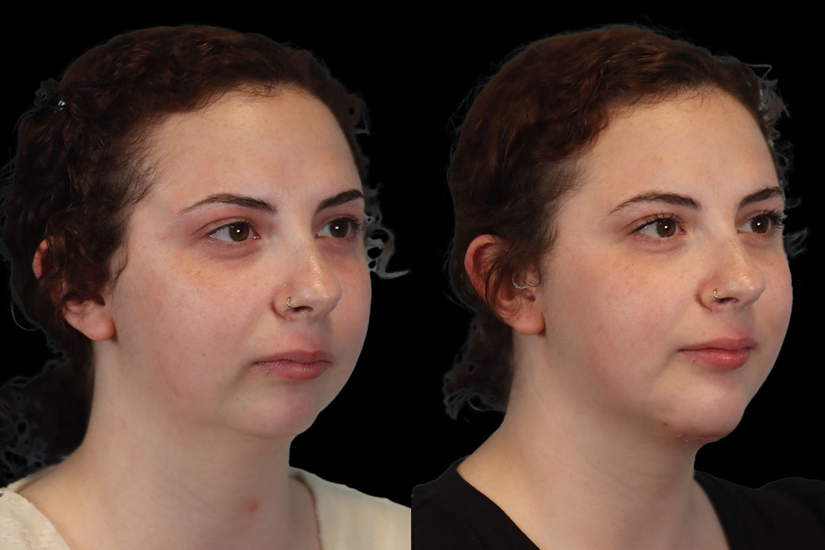 Chin Jaw And Neck Before and After | Leong Facial Plastic Surgery