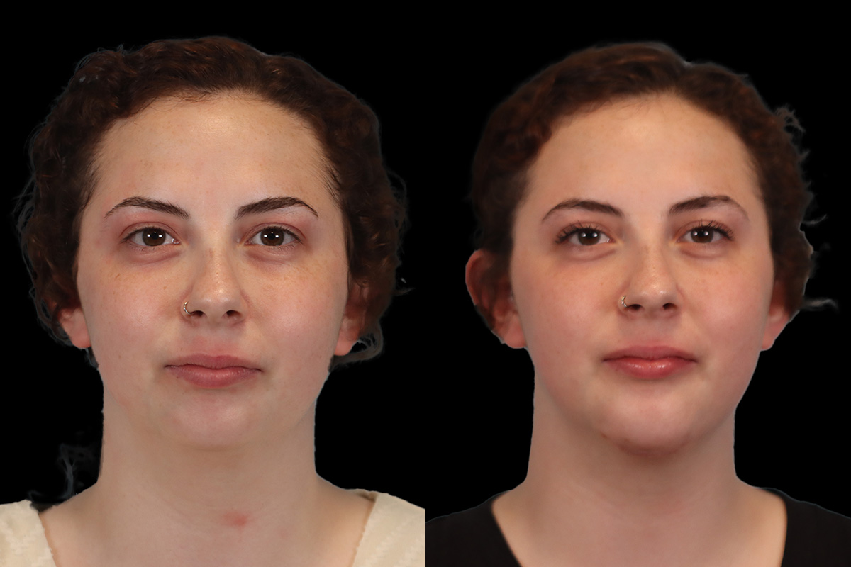 Chin Jaw And Neck Before and After | Leong Facial Plastic Surgery