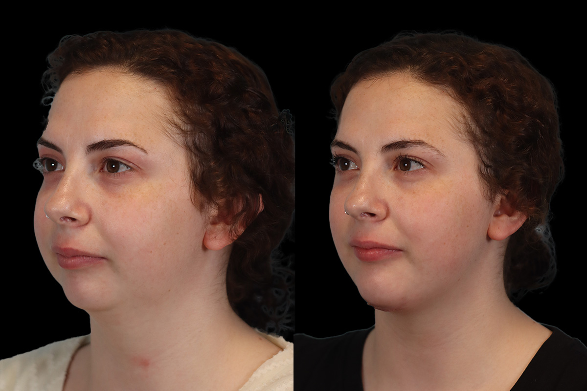 Chin Jaw And Neck Before and After | Leong Facial Plastic Surgery