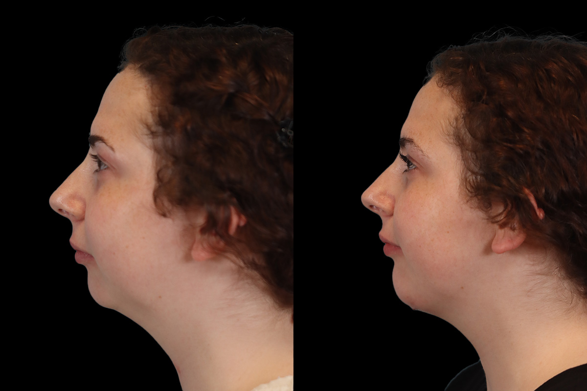 Chin Jaw And Neck Before and After | Leong Facial Plastic Surgery