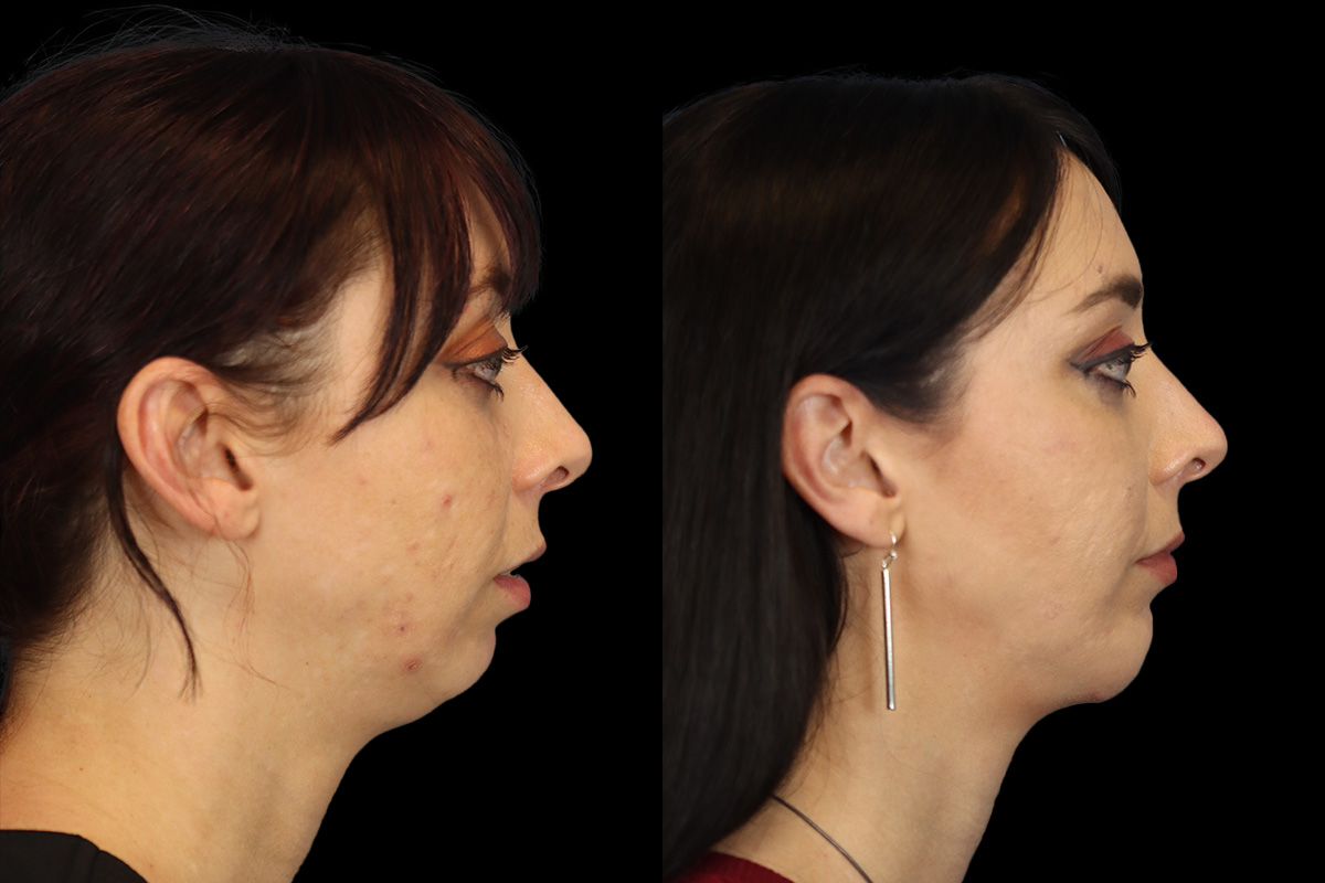 Chin Jaw And Neck Before and After | Leong Facial Plastic Surgery