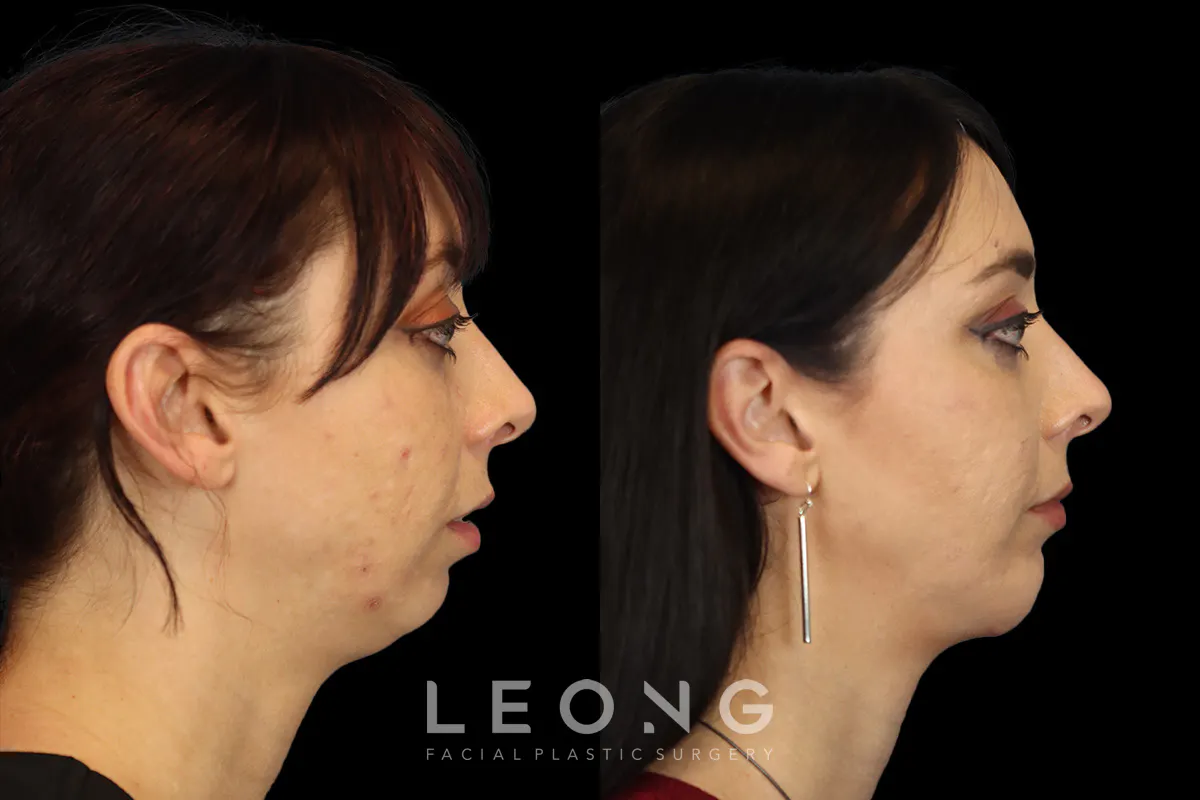 Chin Jaw And Neck Before and After | Leong Facial Plastic Surgery