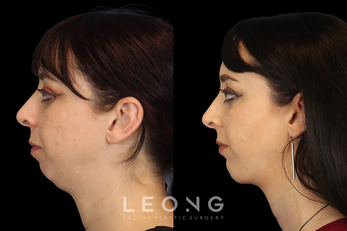 Chin Jaw And Neck Before and After | Leong Facial Plastic Surgery