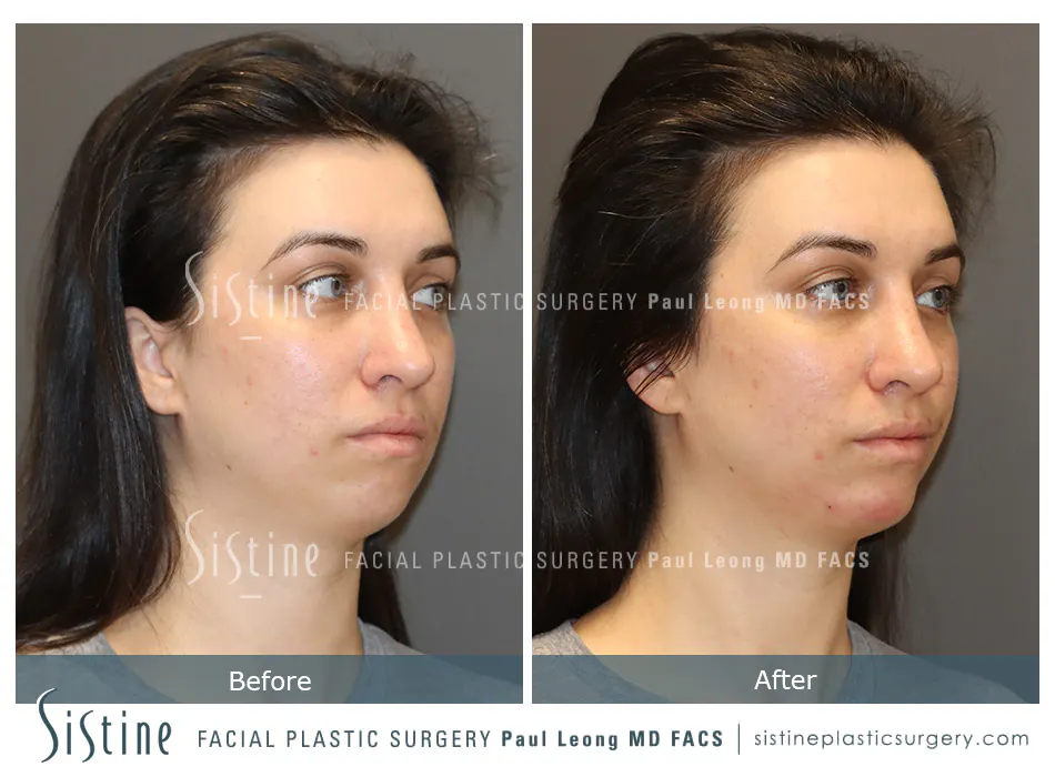 Sewickley PA Non-Surgical Rhinoplasty - BEFORE Photo | Sistine Facial Plastic Surgery