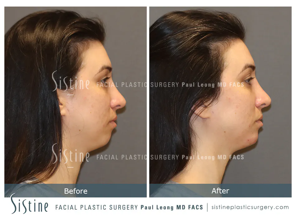 Highland Park Pittsburgh Non-Surgical Rhinoplasty - Before | Dr. Paul Leong - Sistine Facial Plastic Surgery