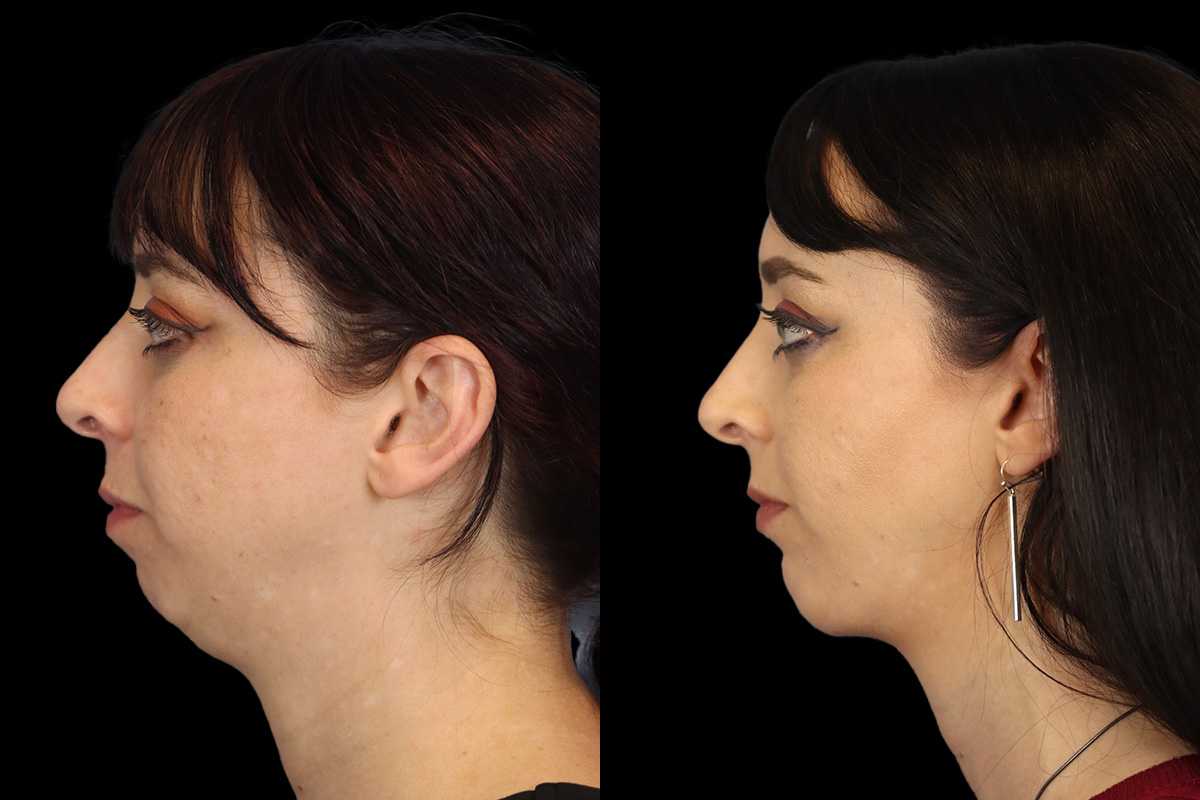 Pittsburgh High SMAS Facelift - Preoperative Left Oblique View | Sistine Facial Plastic Surgery