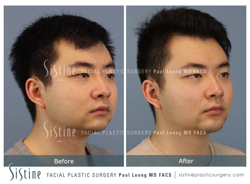 Chin Jaw And Neck Before and After | Leong Facial Plastic Surgery