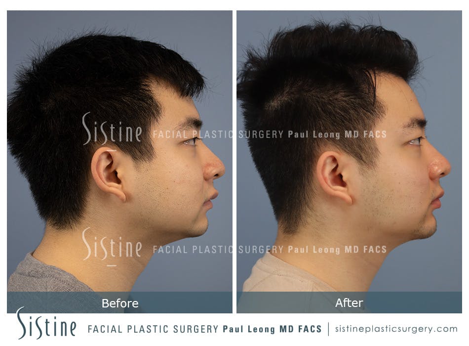Chin Jaw And Neck Before and After | Leong Facial Plastic Surgery