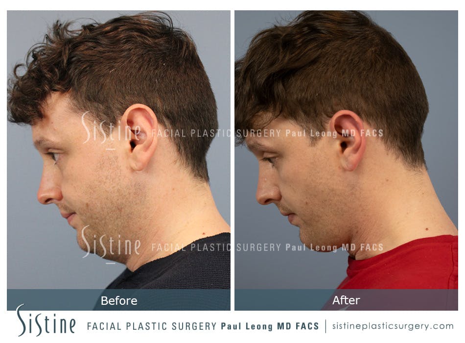 Chin Jaw And Neck Before and After | Leong Facial Plastic Surgery