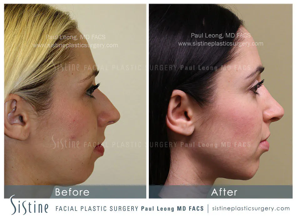 Chin Jaw And Neck Before and After | Leong Facial Plastic Surgery