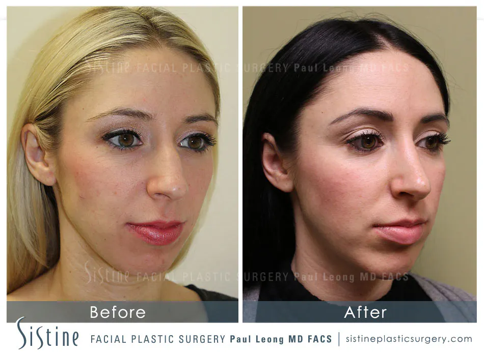 Highland Park Pittsburgh Cosmetic Rhinoplasty - Preoperative Patient Image | Paul Leong MD