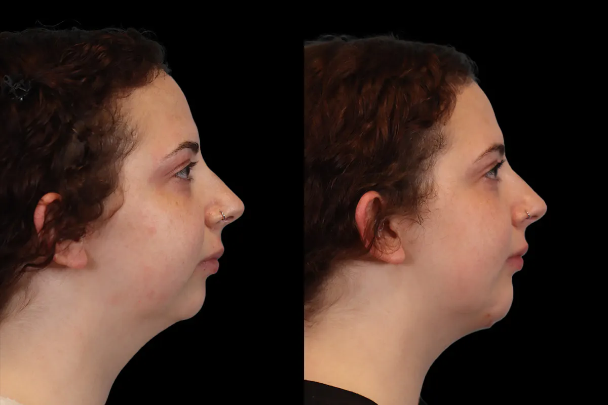 Chin Jaw And Neck Before and After | Leong Facial Plastic Surgery