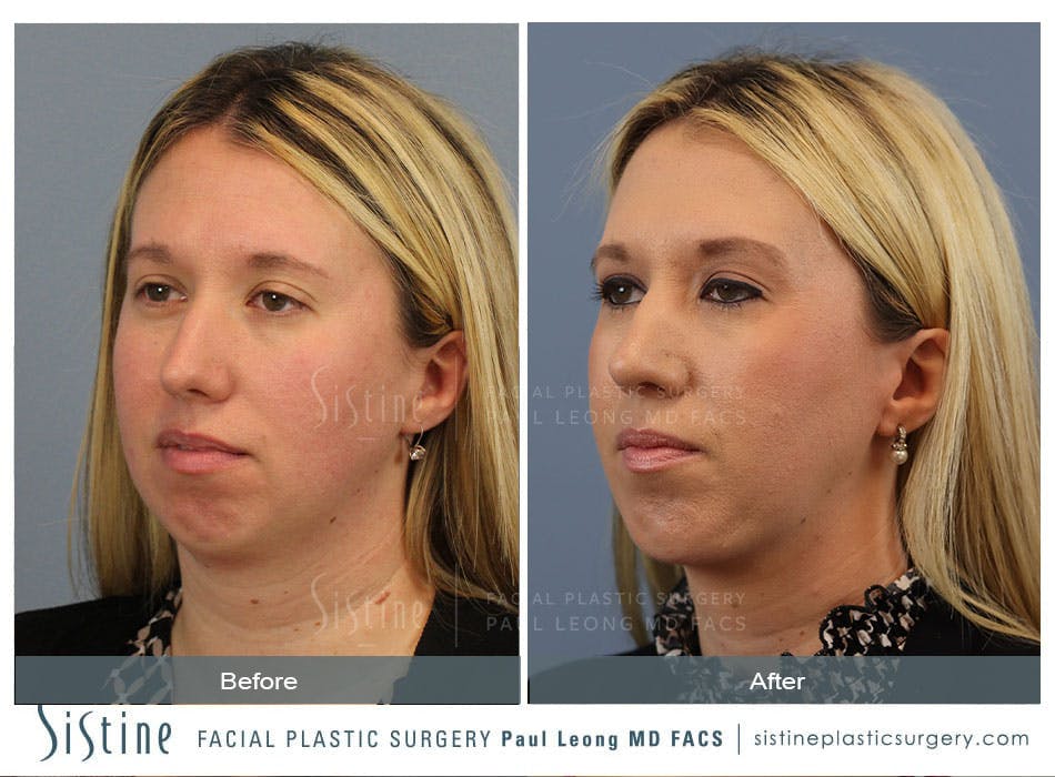 Chin Jaw And Neck Before and After | Leong Facial Plastic Surgery
