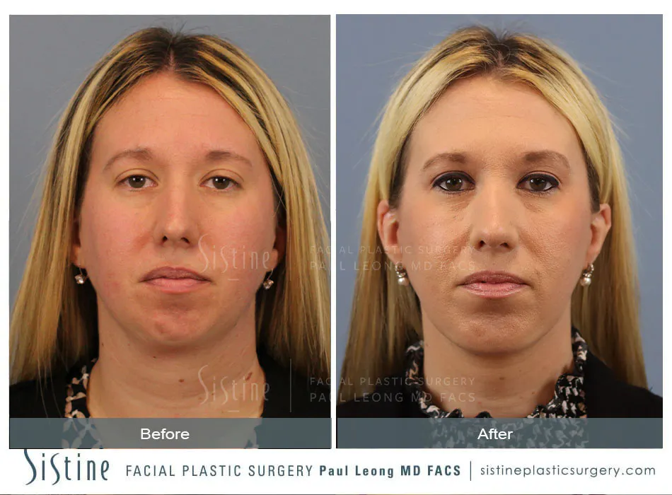 Female Rhinoplasty - Patient Preoperative View | Sistine Facial Plastic Surgery