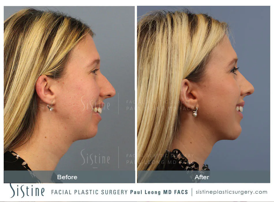 Female Rhinoplasty - Patient Preoperative View | Dr. Paul Leong