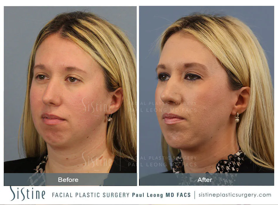 Female Rhinoplasty - Patient Preoperative View | Dr. Paul Leong