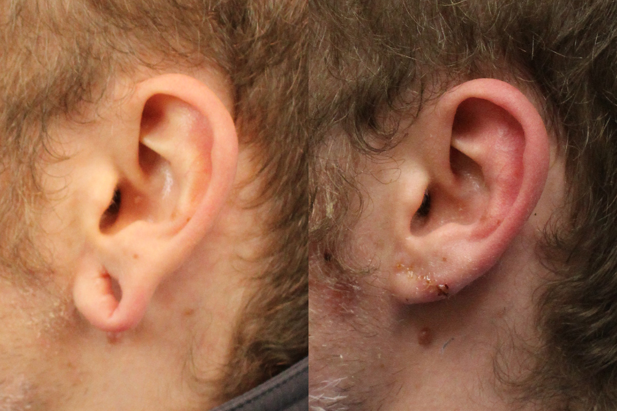 Ears Before and After | Leong Facial Plastic Surgery