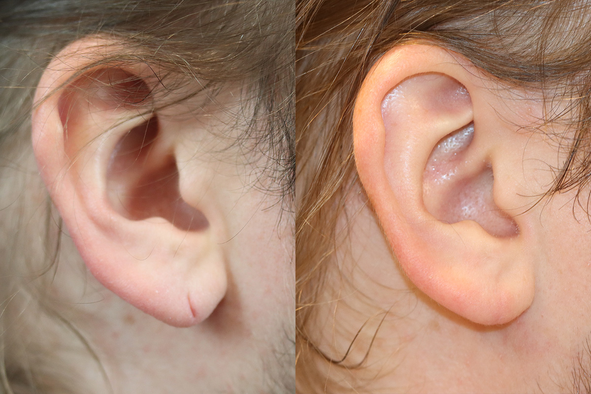 Ears Before and After | Leong Facial Plastic Surgery