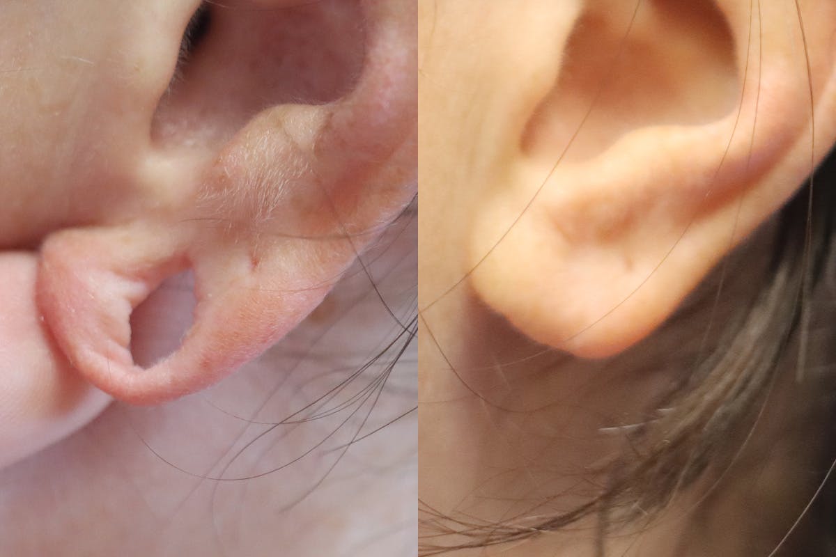 Ears Before and After | Leong Facial Plastic Surgery