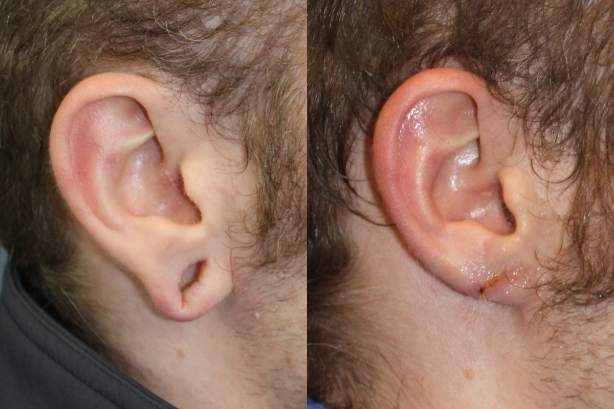 Ears Before and After | Leong Facial Plastic Surgery