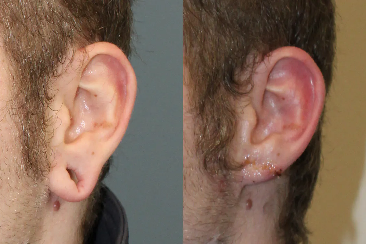 Ears Before and After | Leong Facial Plastic Surgery