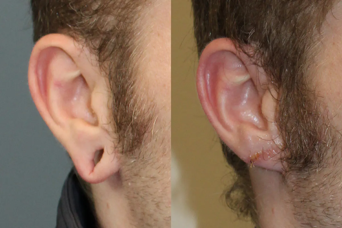 Ears Before and After | Leong Facial Plastic Surgery