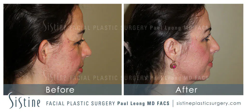 Pittsburgh Plastic Surgery - Preoperative Right Oblique View | Dr. Paul Leong