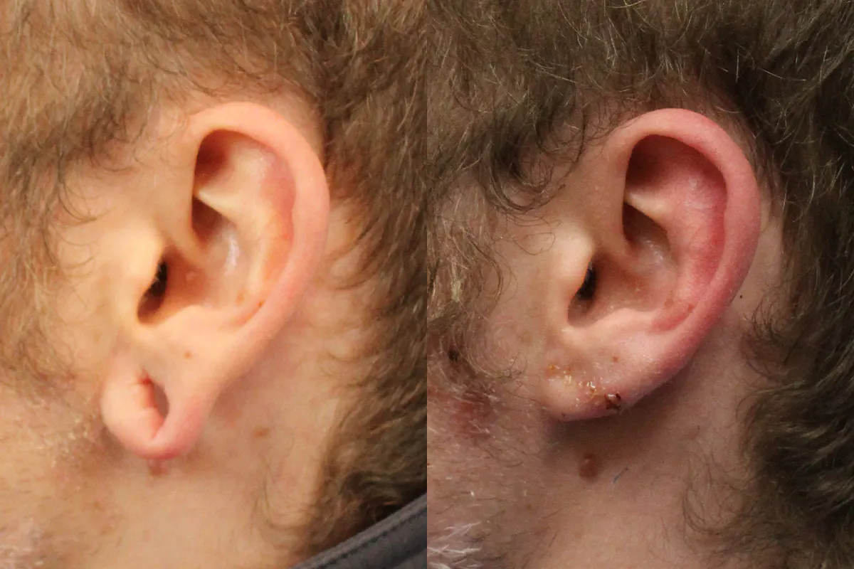 Ears Before and After | Leong Facial Plastic Surgery