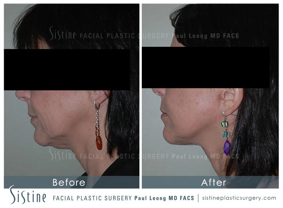 Ears Before and After | Leong Facial Plastic Surgery