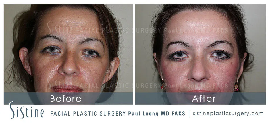 Ears Before and After | Leong Facial Plastic Surgery