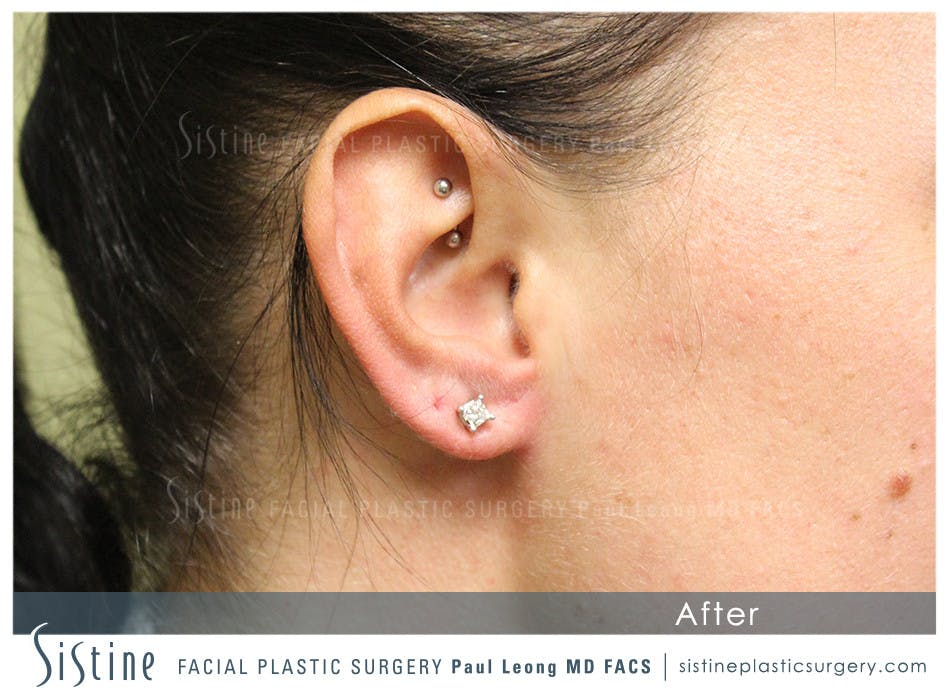 Ears Before and After | Leong Facial Plastic Surgery