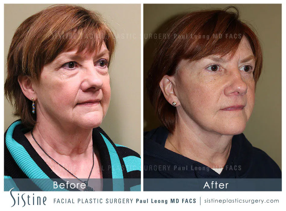 Eyes Before and After | Leong Facial Plastic Surgery