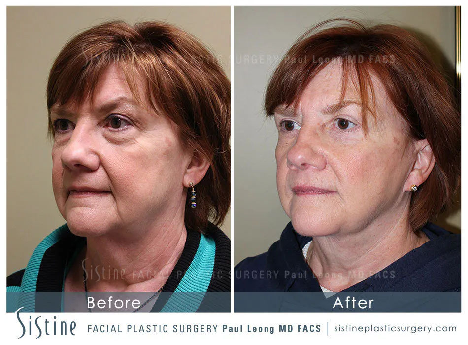 Eyes Before and After | Leong Facial Plastic Surgery