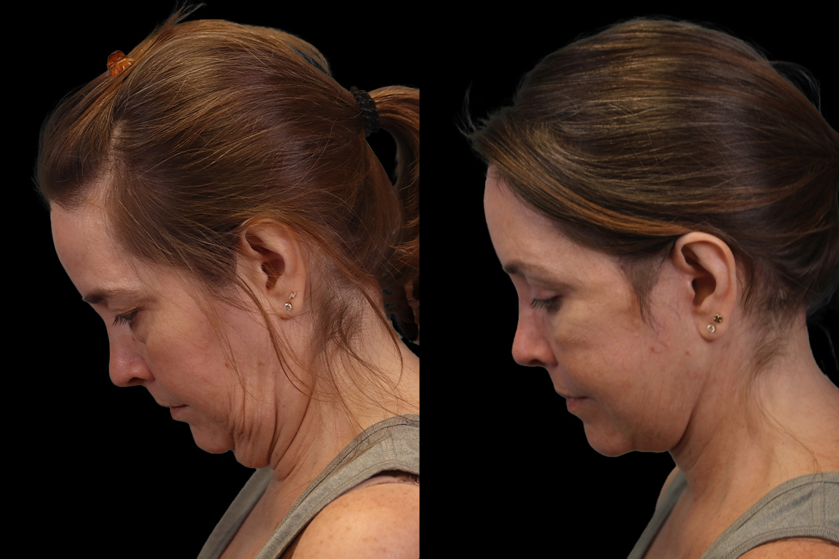  Facelift for Men Pittsburgh - Before Surgery | Sistine Facial Plastic Surgery