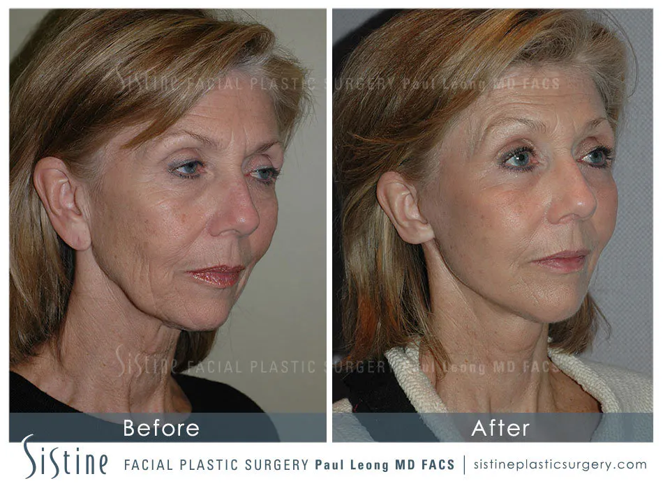 Eyes Before and After | Leong Facial Plastic Surgery