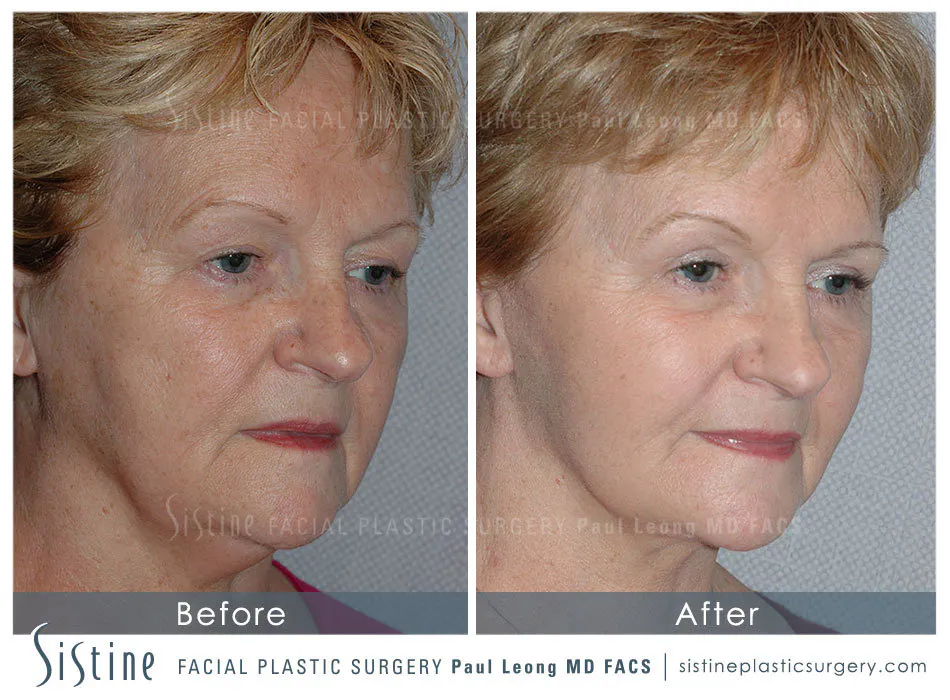 Eyes Before and After | Leong Facial Plastic Surgery