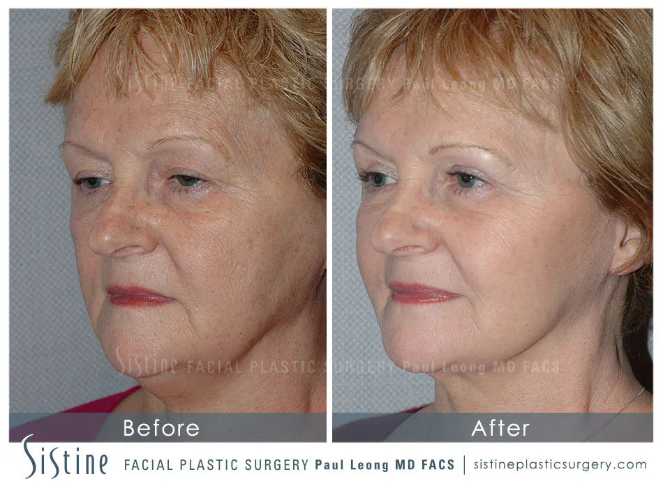 Eyes Before and After | Leong Facial Plastic Surgery