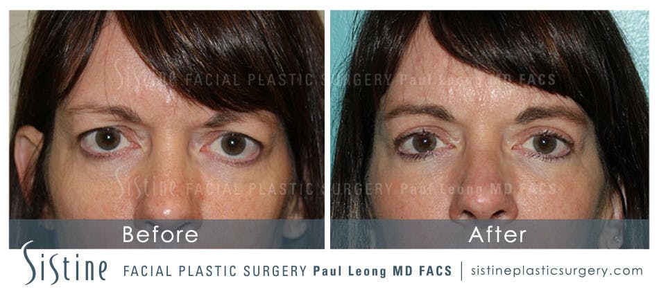 Eyes Before and After | Leong Facial Plastic Surgery