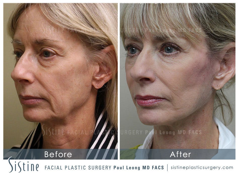 Eyes Before and After | Leong Facial Plastic Surgery