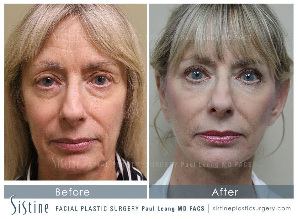 Eyes Before and After | Leong Facial Plastic Surgery
