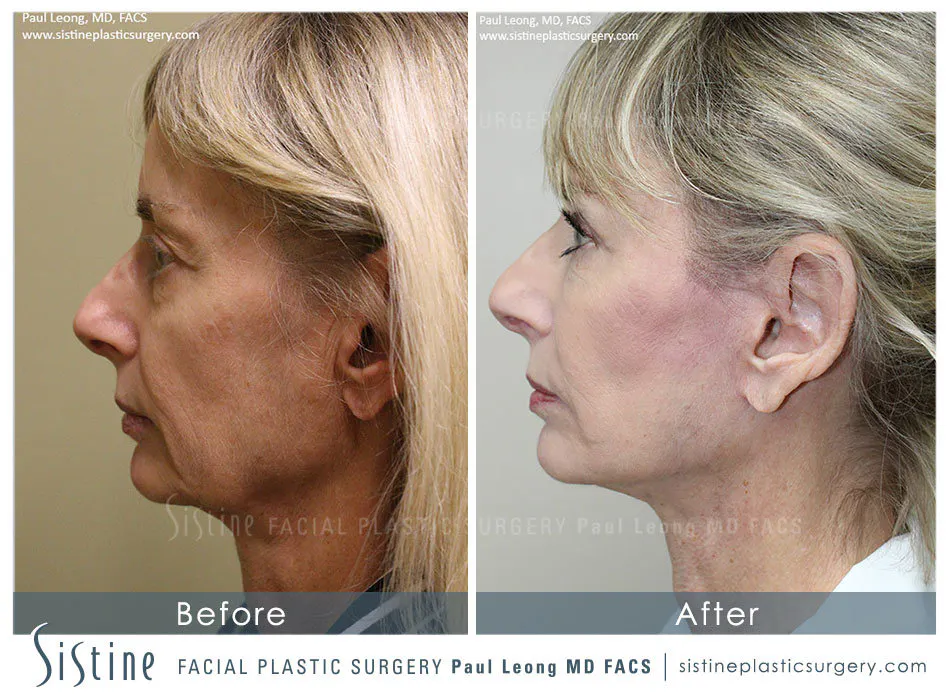Facelifts Wexford PA - Before Image | Sistine Facial Plastic Surgery